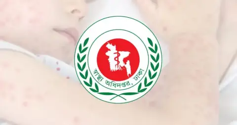হামের উপসর্গে আরও ৩ জনের মৃত্যু, নতুন আক্রান্ত ১,২৬৮ জন